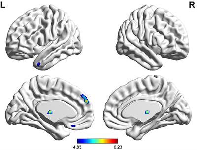 Cerebral gray matter volume changes in patients with anti-N-methyl-D-aspartate receptor encephalitis: A voxel-based morphometry study